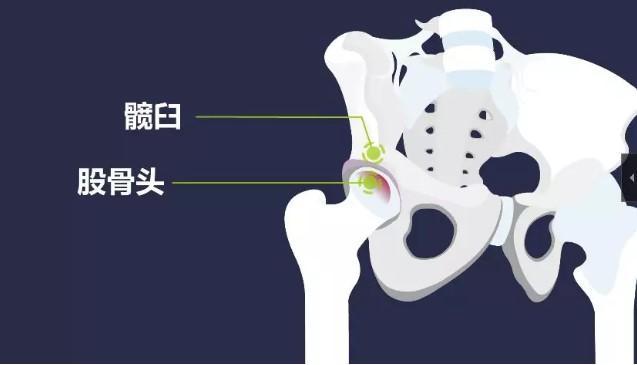 位置时出现弹响,若未及时治疗,髋臼盂唇损伤最终可导致髋关节关节软骨