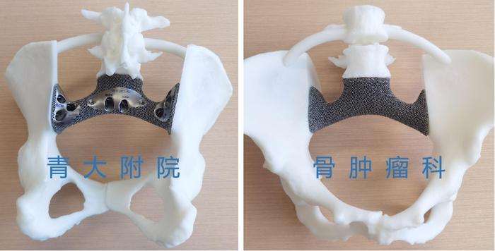 典型病例全骶骨腰5全椎体3d打印一体化假体在复杂腰骶肿瘤切除重建中