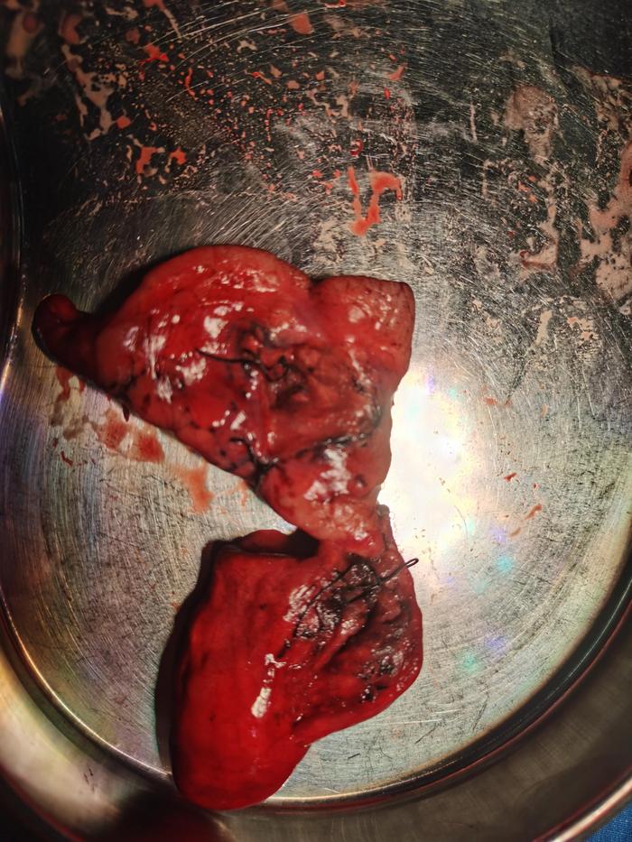 肺磨玻璃结节小结节进展形成的微浸润腺癌肺癌可以完全治愈的最后一道