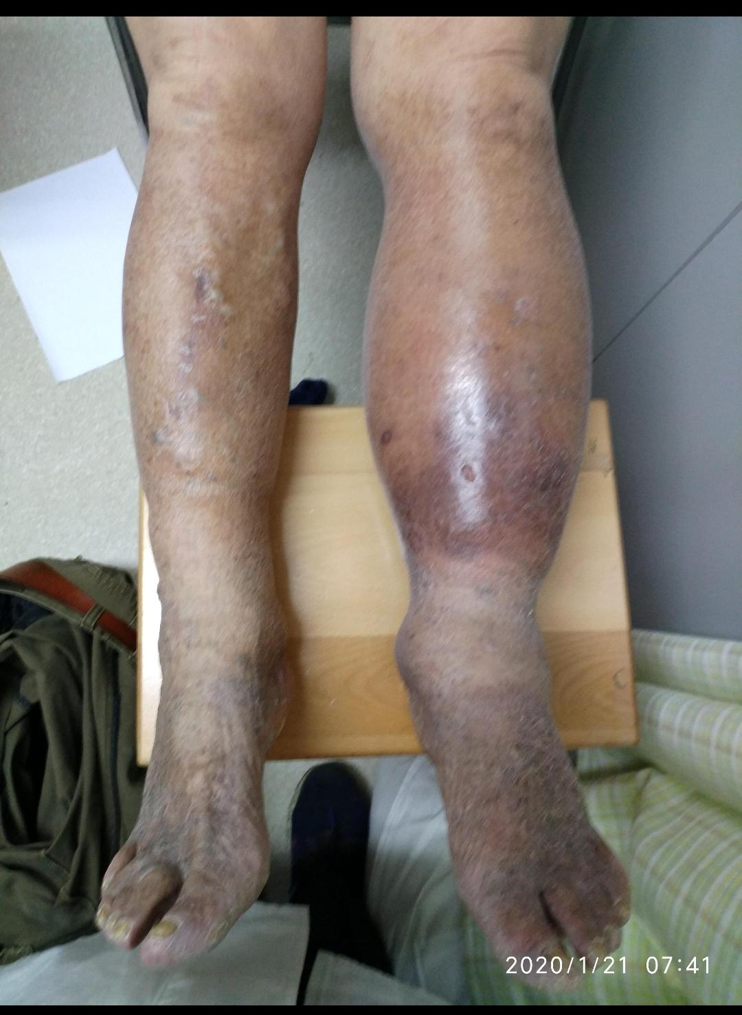 淋巴水肿治疗前后图片对比1_黄晓春医生文章_复旦大学附属中山医院