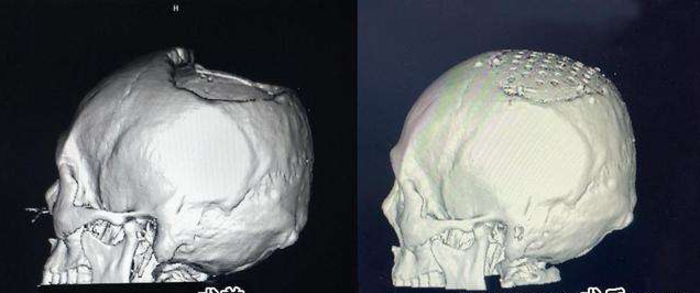 peek材料颅骨修复手术风险大吗