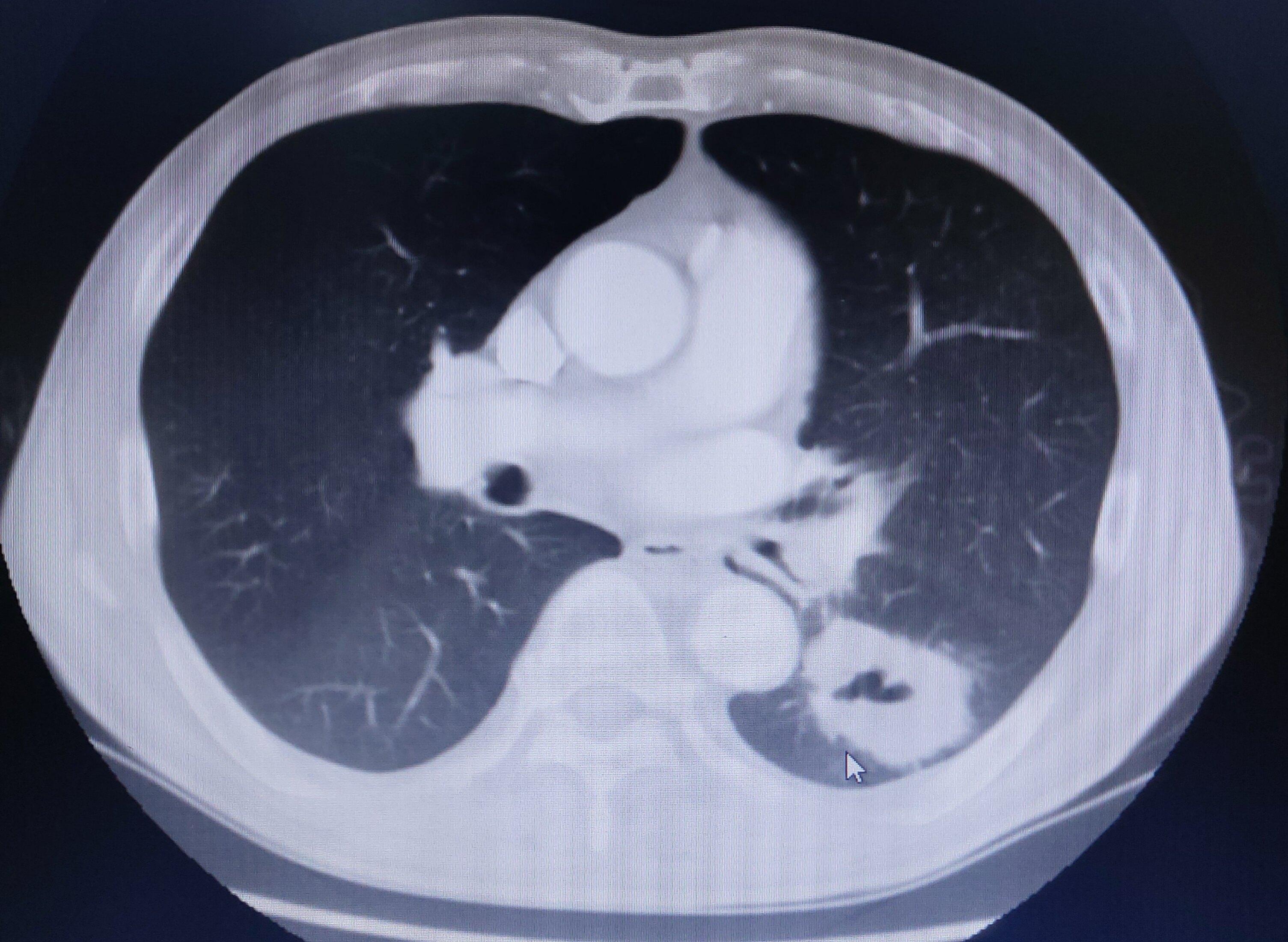 刘懿博士说肺癌(一五〇五)五厘米肺占位竟然是原位癌,可.