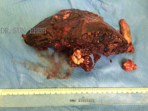 病例一晚期肝癌的根治性切除