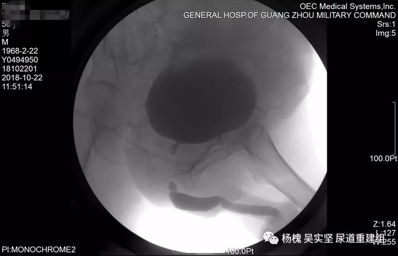 复杂的长段创伤性后尿道闭锁治疗含手术视频