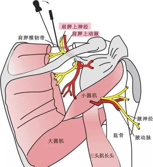 肩部疼痛常见原因——肩胛上神经卡压综合征