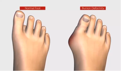 拇外翻最佳治疗方法_赵会医生文章_首都医科大学附属北京朝阳医院