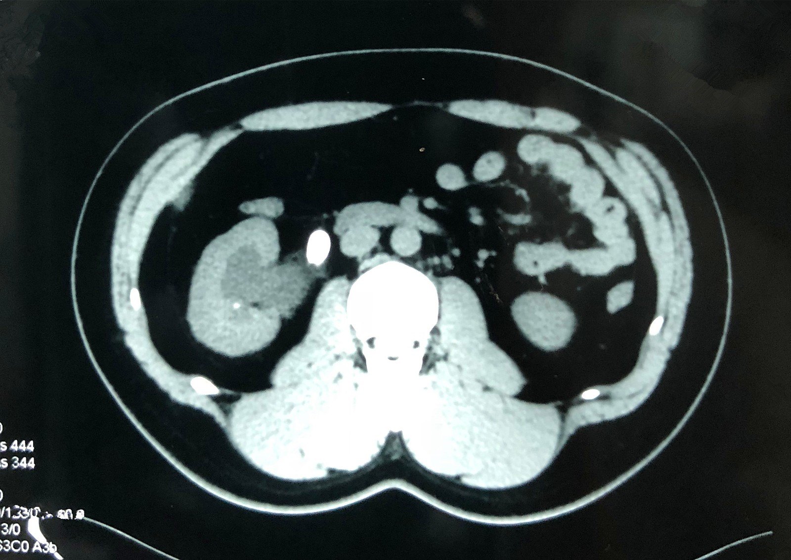 震波碎石后复查ct提示右侧肾盂输尿管连接部小结石,右输尿管中下段