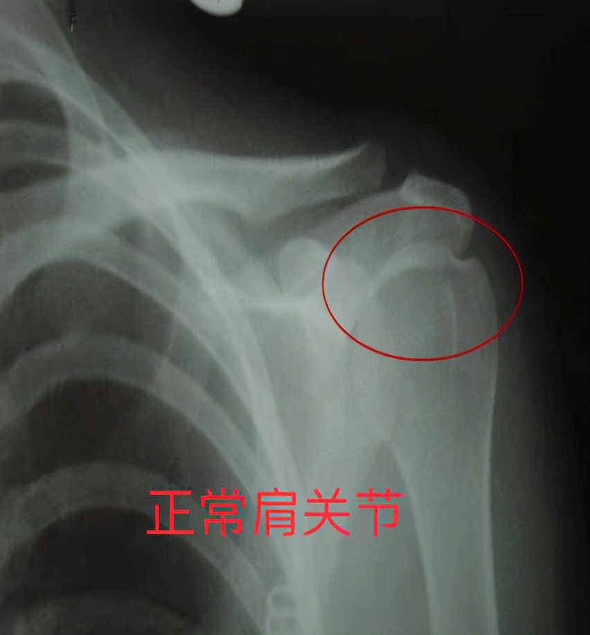 中风患者肩关节半脱位x线图三,护理不当.