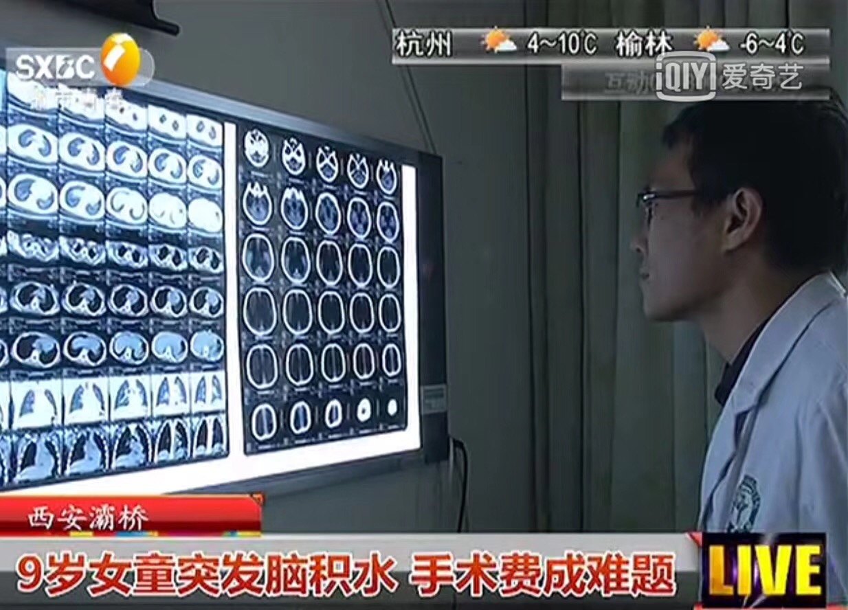 被脑积水夺走童年快乐的小天使