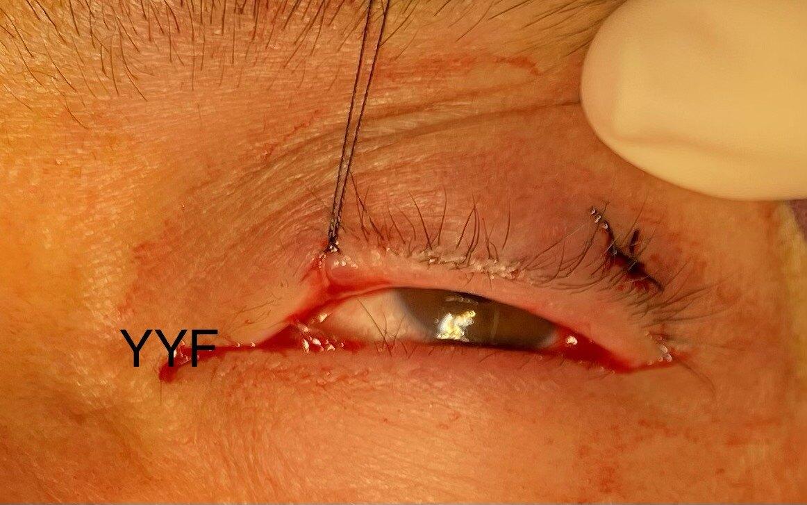 眼睑肿块系列之二睑缘霰粒肿手术宜早不宜迟