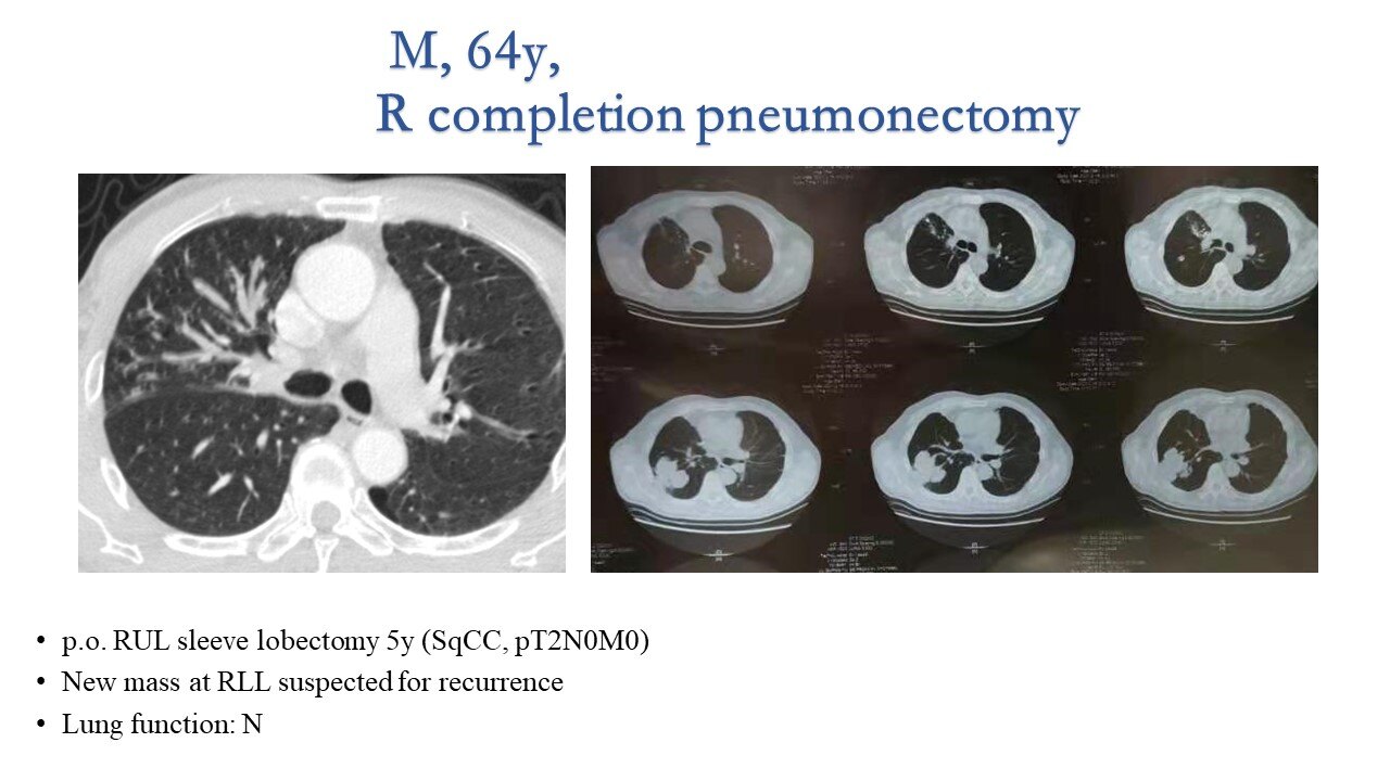 肺癌复发还能二次手术吗肺癌复发还能活多久