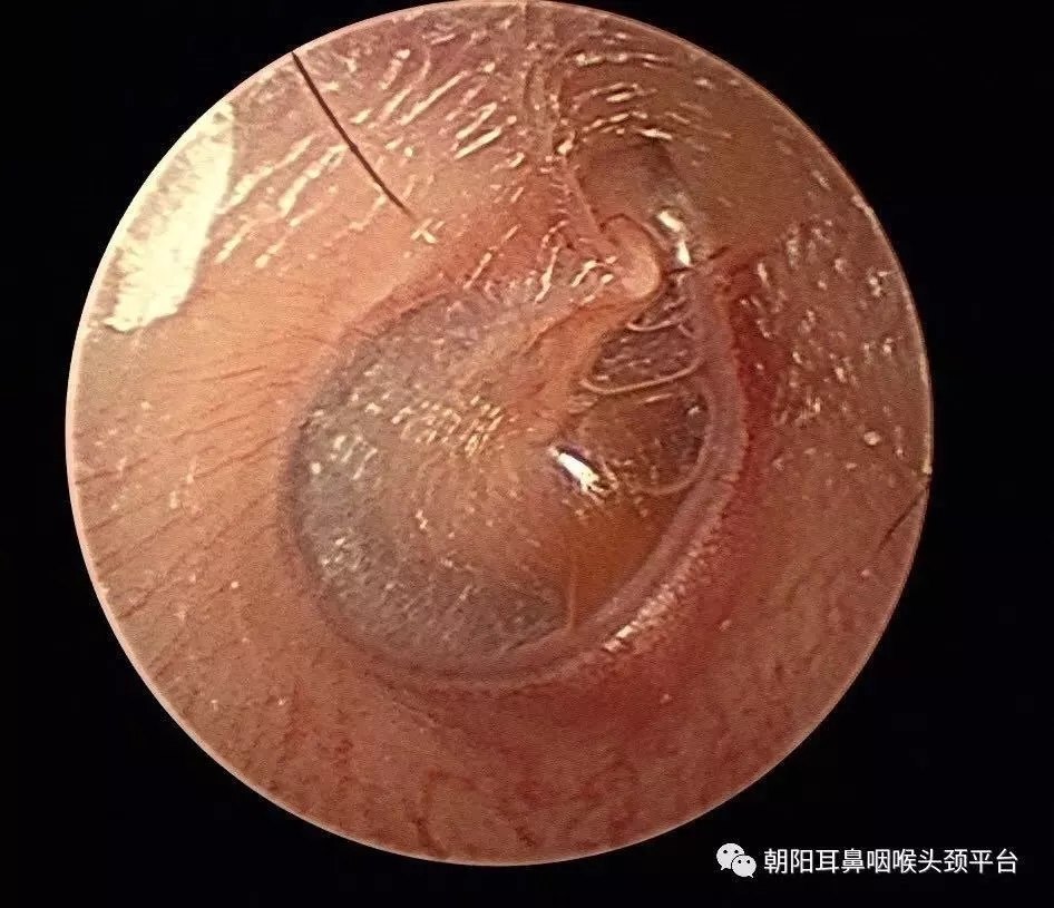 气压创伤性中耳炎又名航空性中耳炎,是耳鼻咽喉头颈外科临床常见病,是