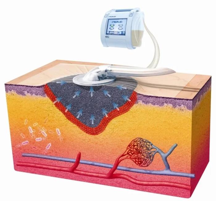 图文解码真空辅助闭合伤口（溃疡）VAC 微医（挂号网）