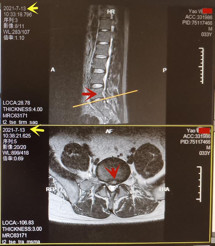 姚先生l5-s1椎间盘突出,红箭头.图5.姚先生训练.3.