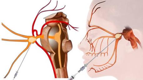 球囊压迫术是在面部用穿刺针将球囊导入到三叉神经半月节部附近,通过