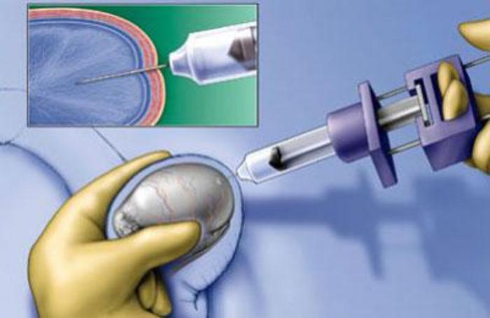 无精症还能生育吗江西省无精症诊疗中心助你成就男人爸业