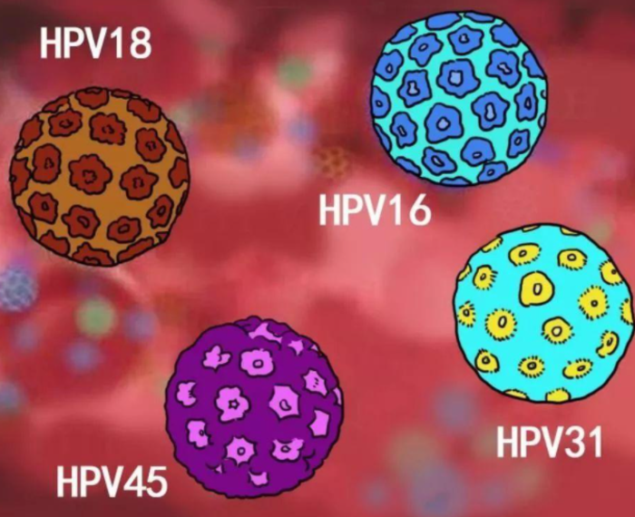 其实,导致宫颈癌的元凶是hpv病毒 .