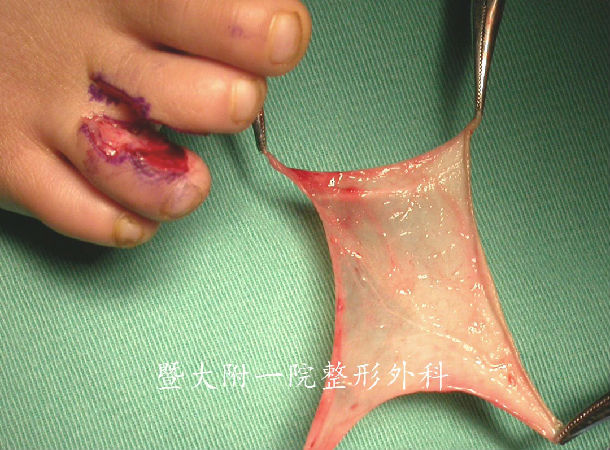 包皮在先天性并指趾畸形矫治中的应用