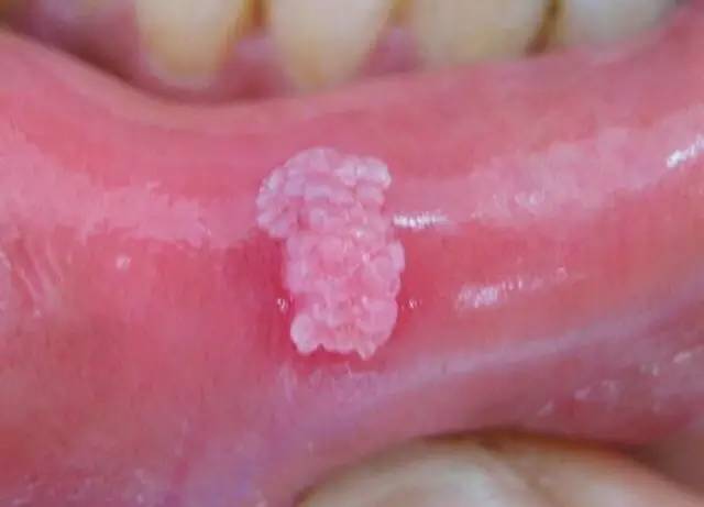 可见菜花状新生物从以上图片可以看出:口腔尖锐湿疣皮疹隆起呈乳头状