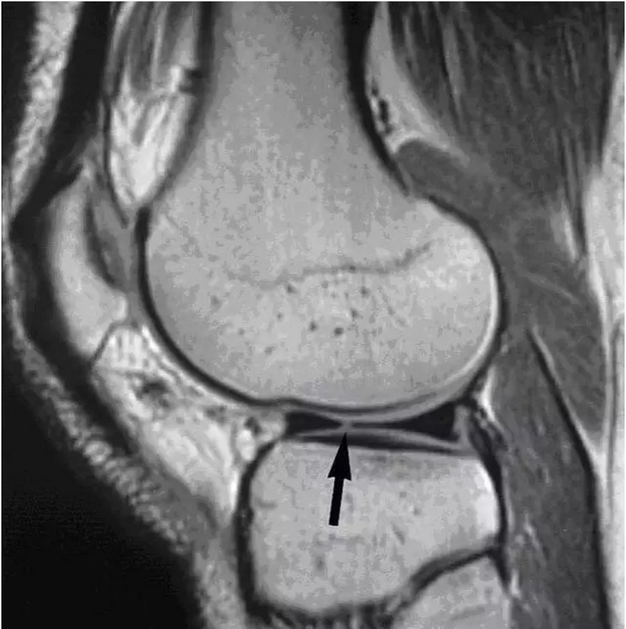 图 11 内侧半月板桶柄状撕裂——双后交叉韧带征(点击查看相关文章).