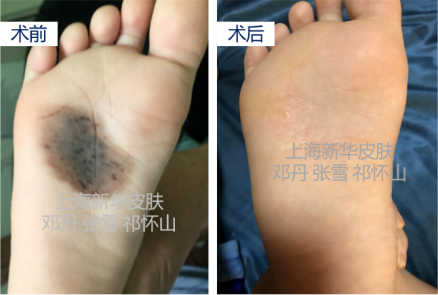 近期我们分享了关于小腿,手背,足底等部位的较大面积的先天性色素痣
