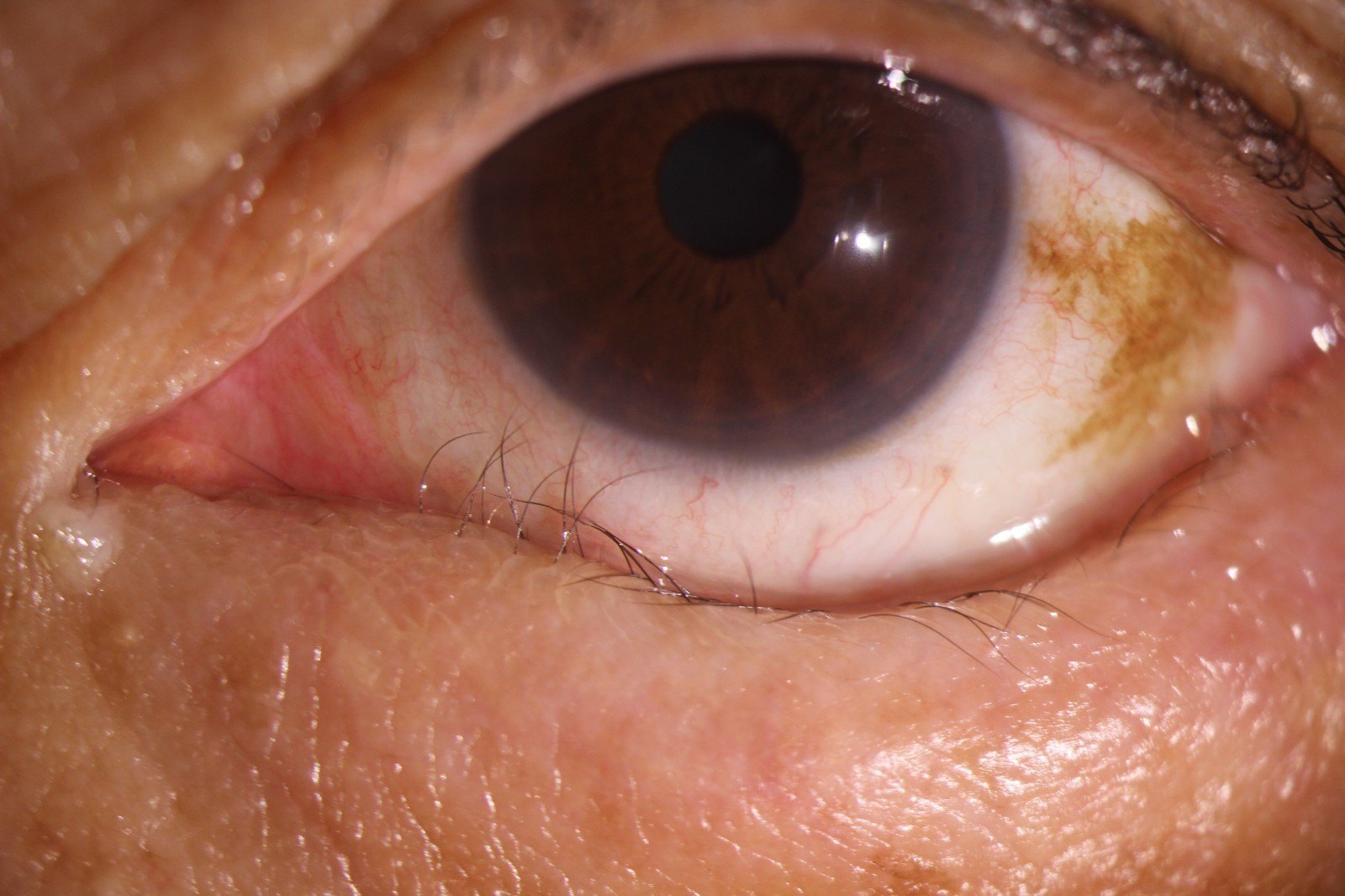 任性眼睑内翻本是护卫反戳主人多图