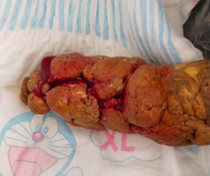 大便带血到底是肛裂还是肠息肉如何肉眼识别