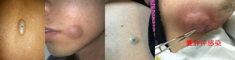 皮脂腺囊肿 粉瘤 健康号 微医