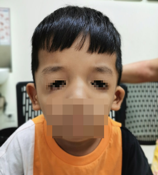 treacher-collins综合征是什么?