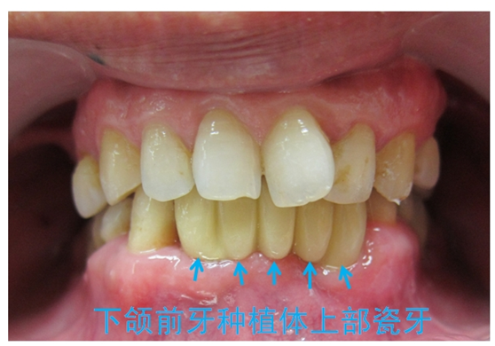 种牙痛吗?什么人可以种牙?种牙使用寿命、费