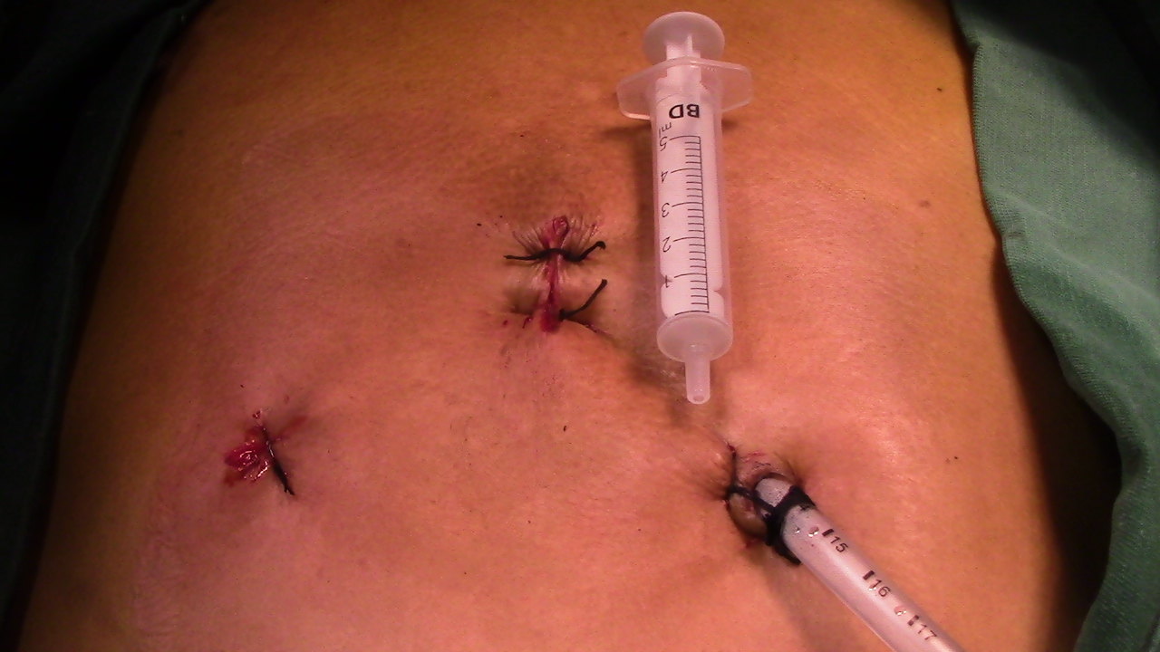 经剑突胸腔镜下巨大心包囊肿切除术在省胸科心外科成功