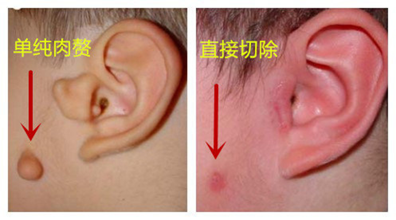 宝宝附耳拴马桩并非是福耳手术不能直接一切了之