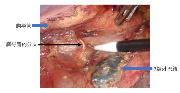 使术中能够清楚地看到胸导管及其分支,避免损伤