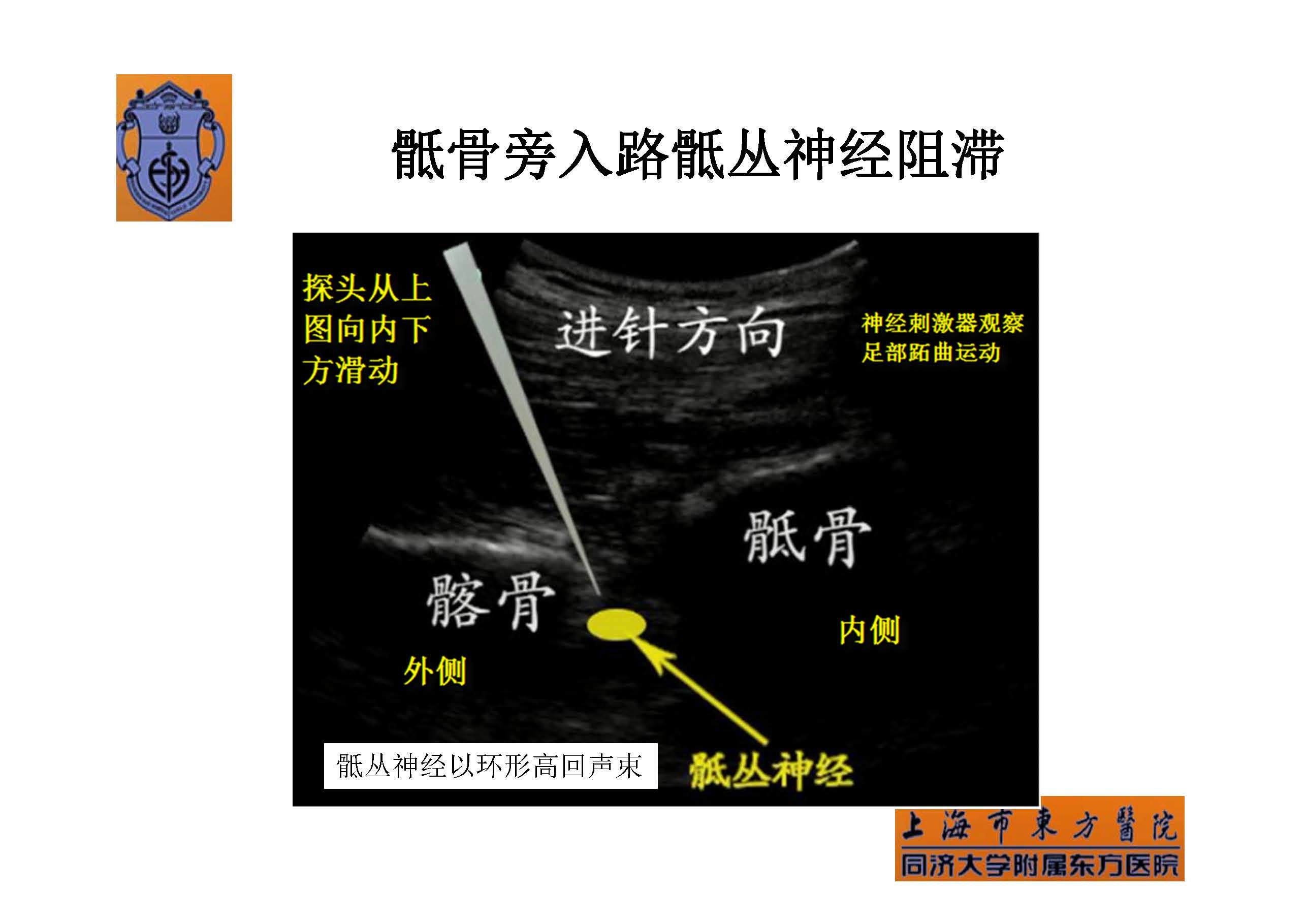 实用骶丛神经阻滞