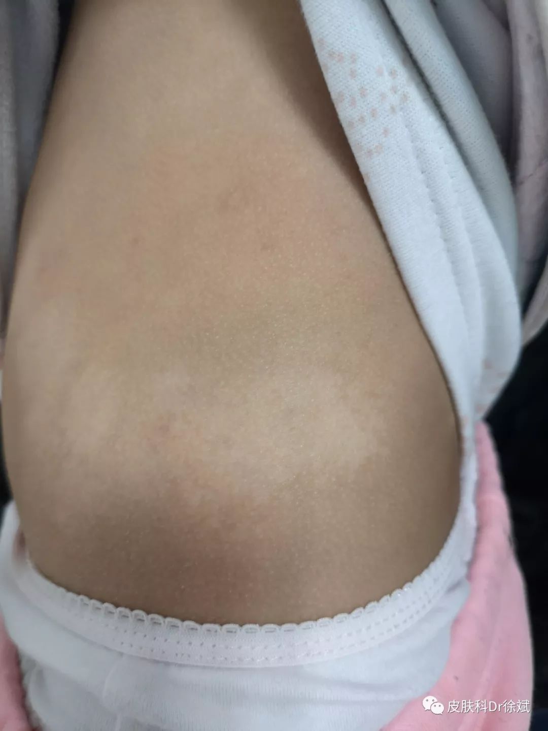 3号嫌疑犯:无色素痣