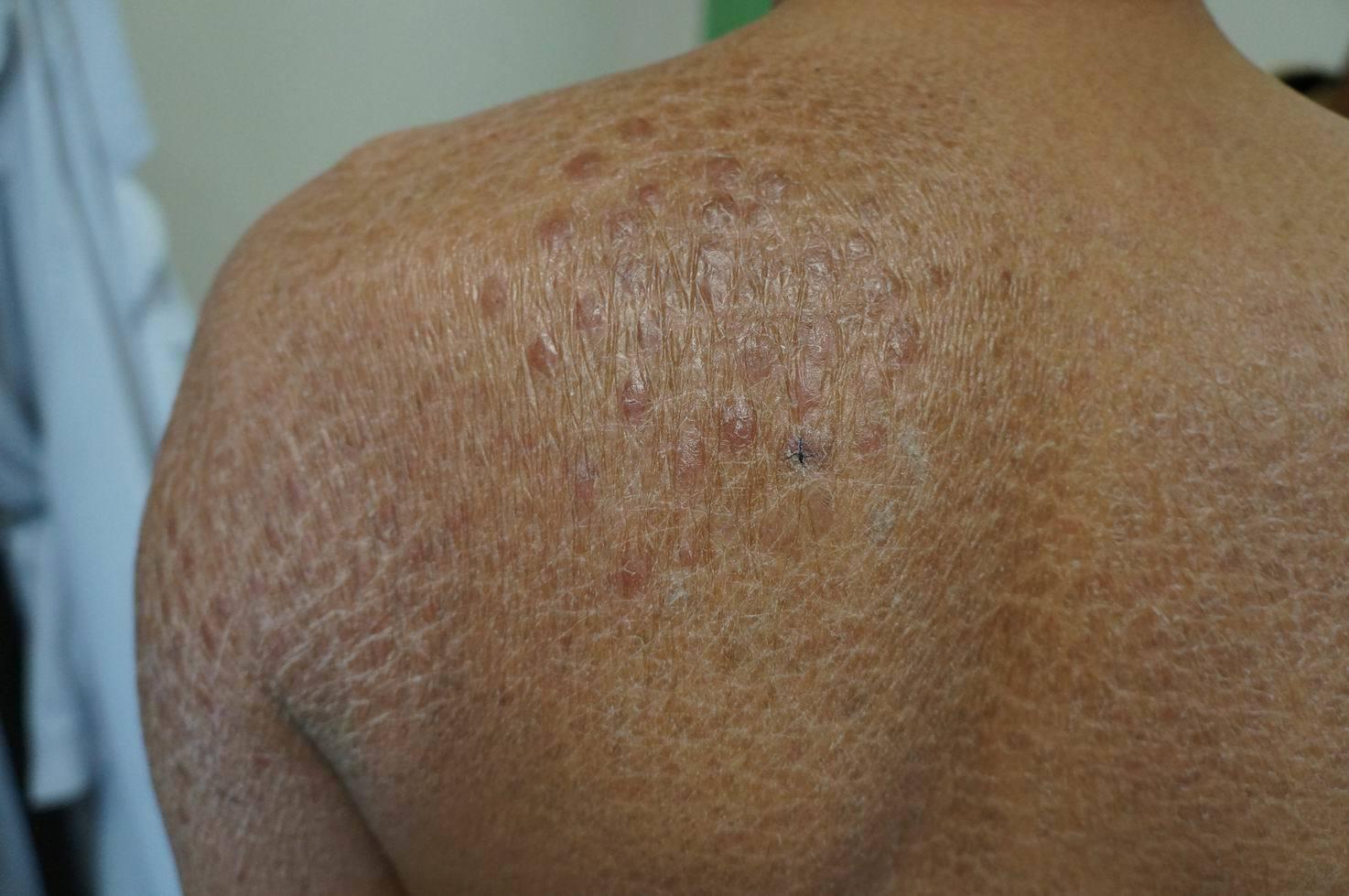 a君的四肢鱼鳞病的鳞屑和手掌掌纹的紊乱程度不呈比例,我很警觉地问了