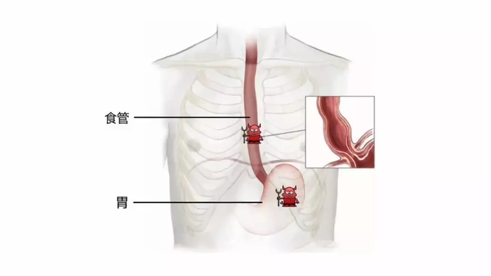 食管癌合并胃癌的手术治疗什么是多原发恶性肿瘤