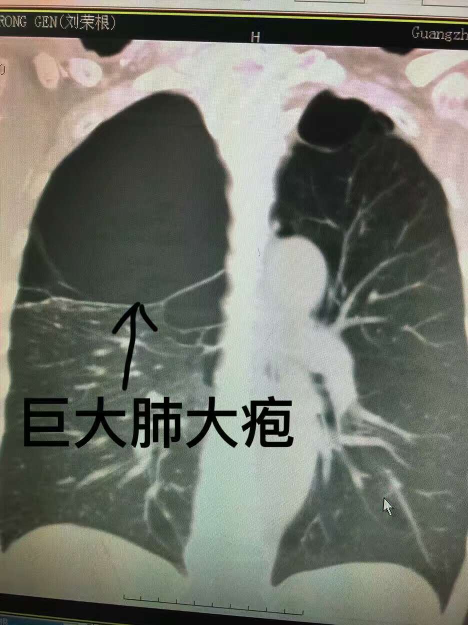 肺泡破裂图片