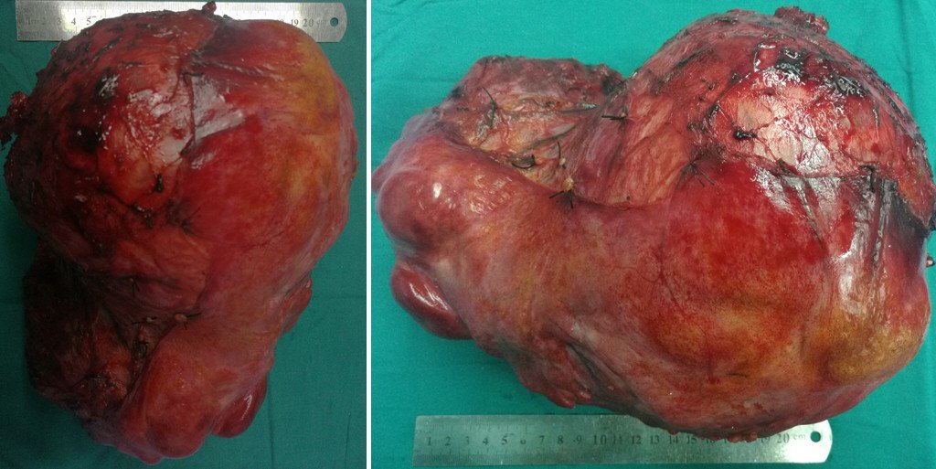 郑阳春医生文章_四川省肿瘤医院-微医