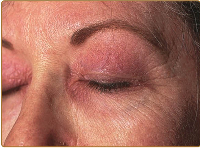 双眼水肿发红疹真的只是皮肤过敏吗