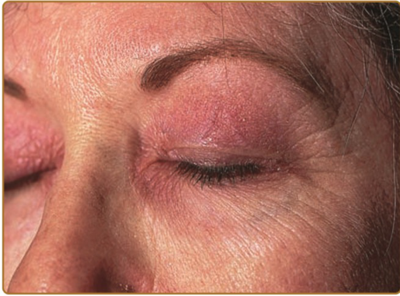 双眼水肿 发红疹真的只是皮肤过敏吗 健康号 微医