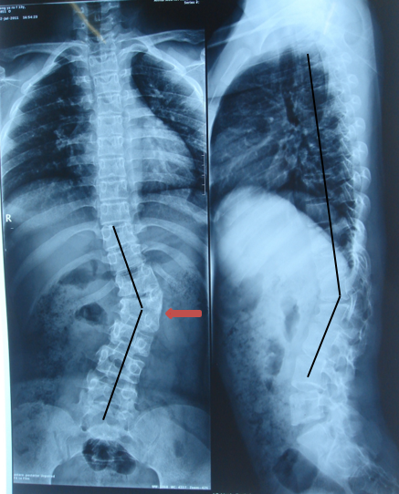 先天性脊柱侧弯1半椎体畸形