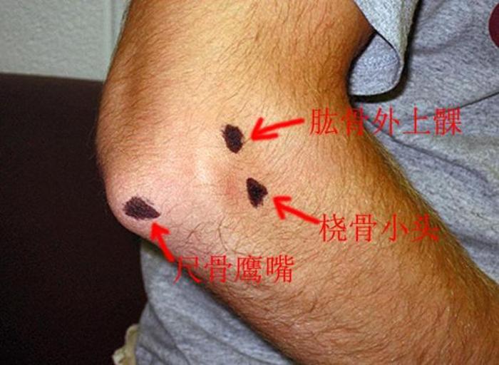 为什么会出现网球肘?