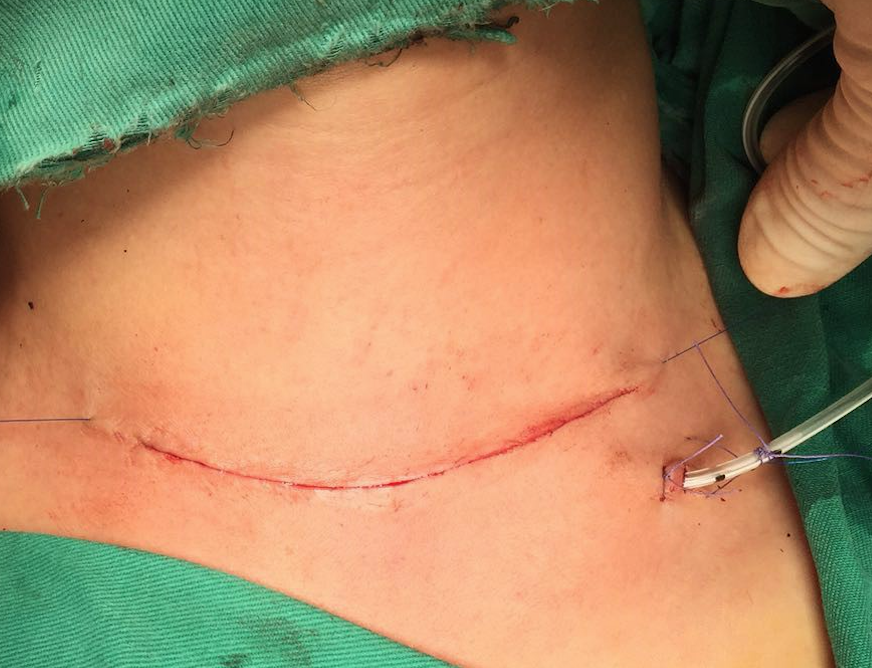 吉大一院甲状腺外科门诊检查及住院手术流程