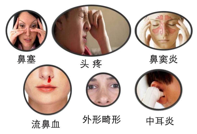 鼻中隔偏曲需要治疗吗 健康号 微医