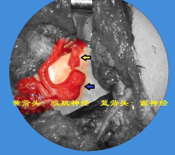 面瘫手术治疗专题一咬肌神经吻合术附病例照片