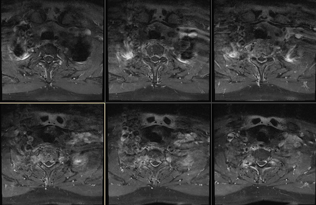 胸椎脊柱转移瘤胸1病例分享