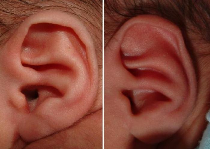 耳廓后上方异常突出,以形成第3对耳轮脚为主要特征