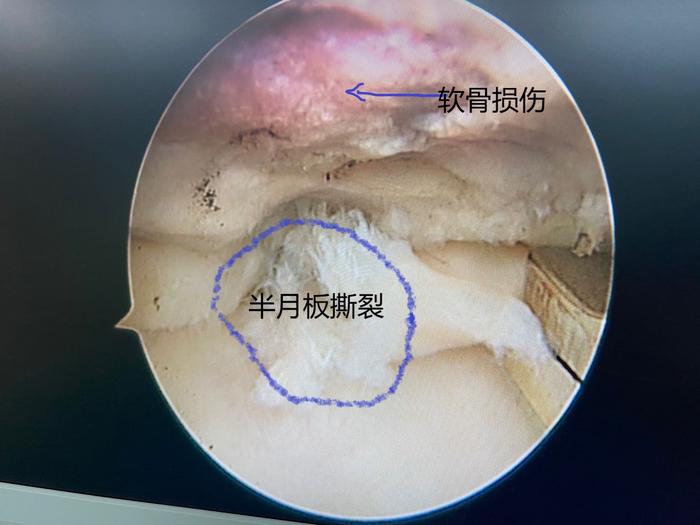 膝关节疼痛肿胀原因关节鼠