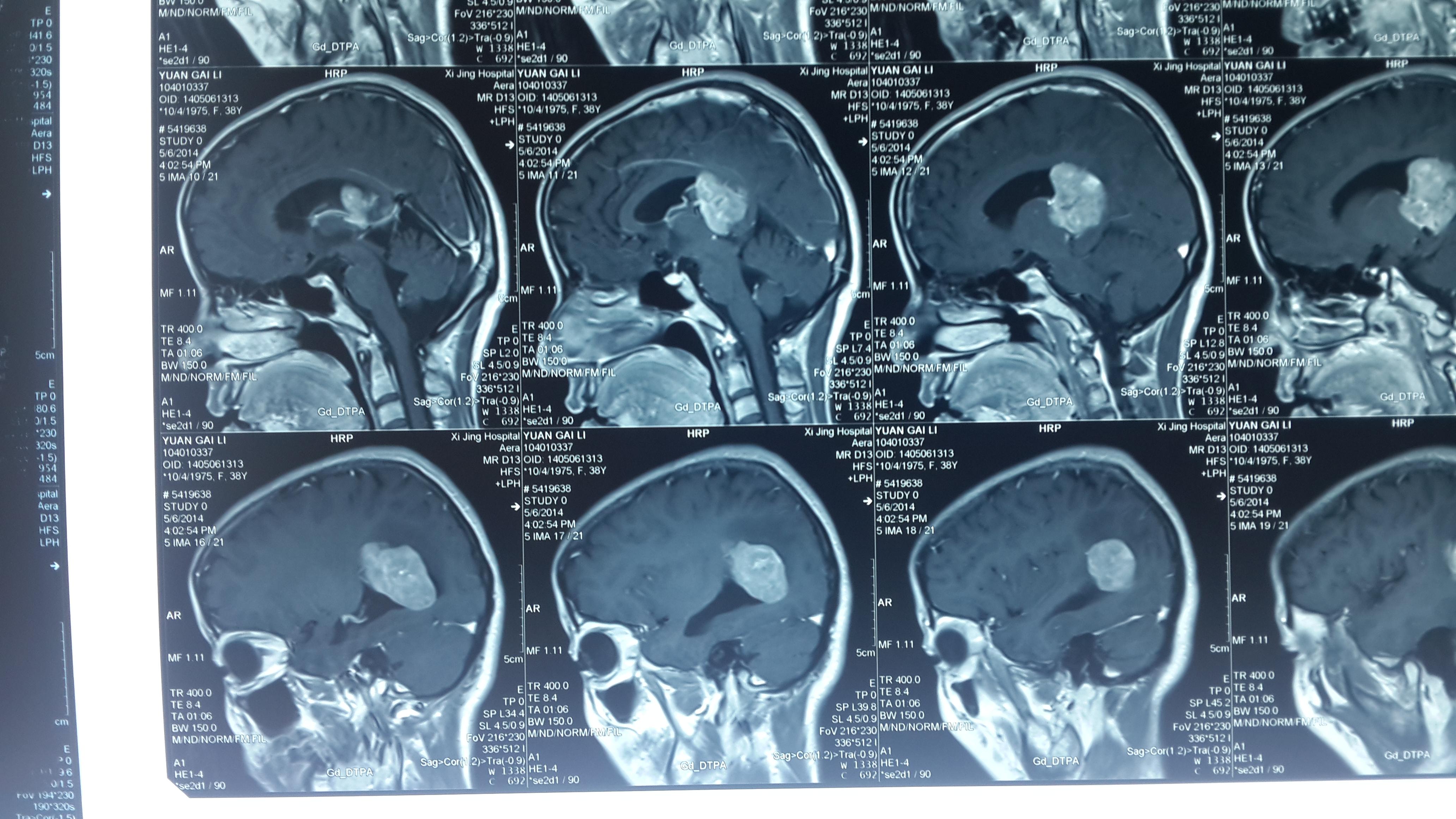 侧脑室脑膜瘤手术完整切除